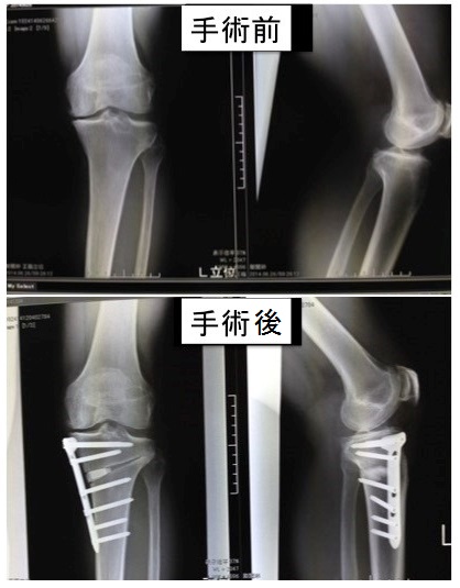 大阪医科薬科大学整形外科学教室 » 膝関節の外科