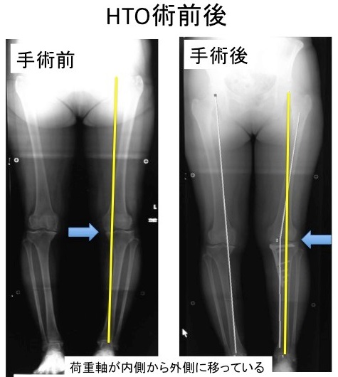 大阪医科薬科大学整形外科学教室 » 膝関節の外科