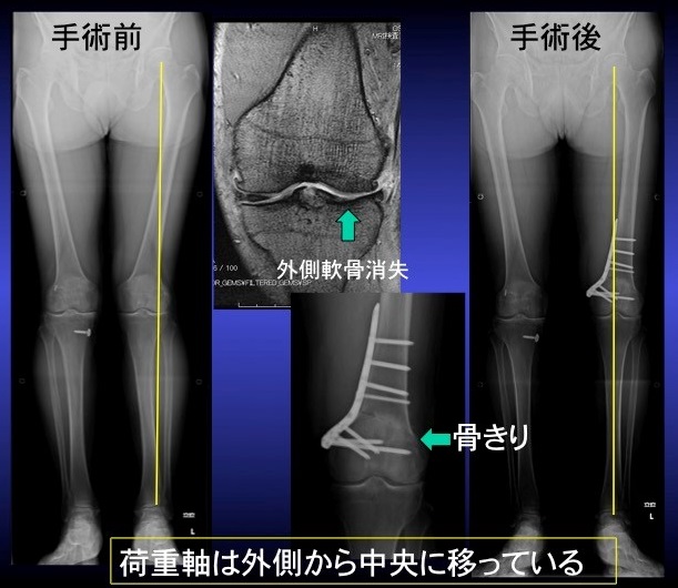大阪医科薬科大学整形外科学教室 » 膝関節の外科