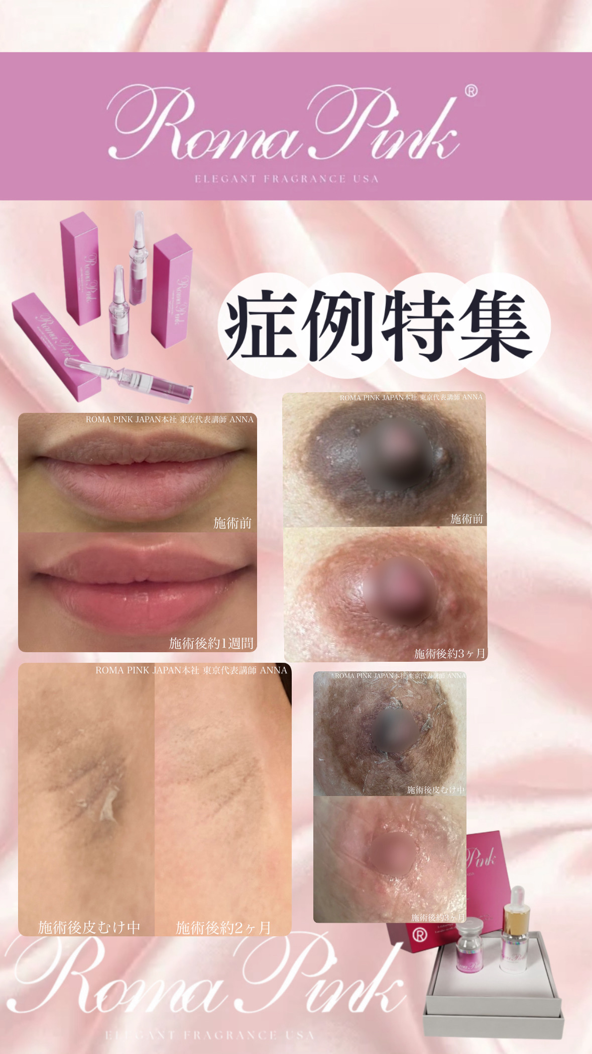 ROMA PINK】看護師施術で安心。ローマピンクで唇・乳輪のくすみを自然