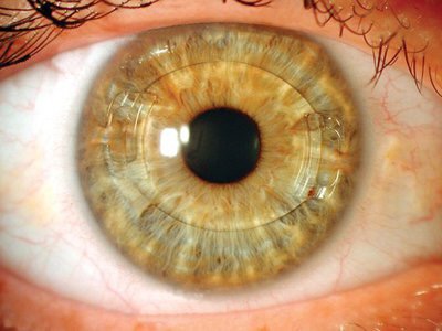 有水晶体眼内レンズ抜去を伴う白内障手術 | 柳津あおやま眼科クリニック