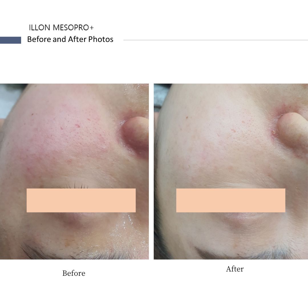 iLLON 【iLLON肌再生セット】MESOPRO®+&鎮静マスク / DOCTOR EXPRESS