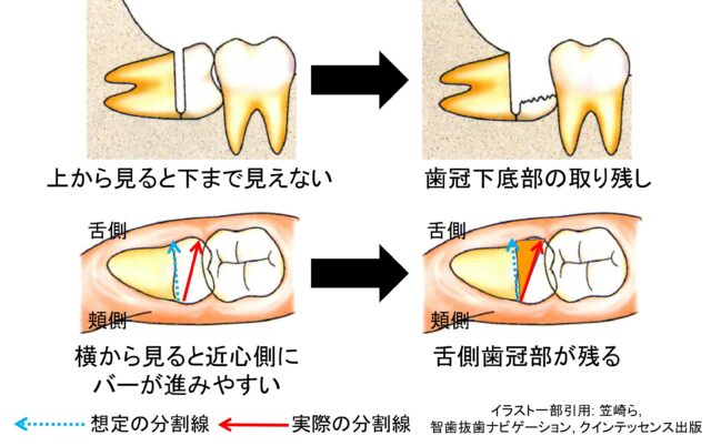 埋伏智歯抜歯の方法と種類について【歯科医療従事者向け】 | 歯と口腔