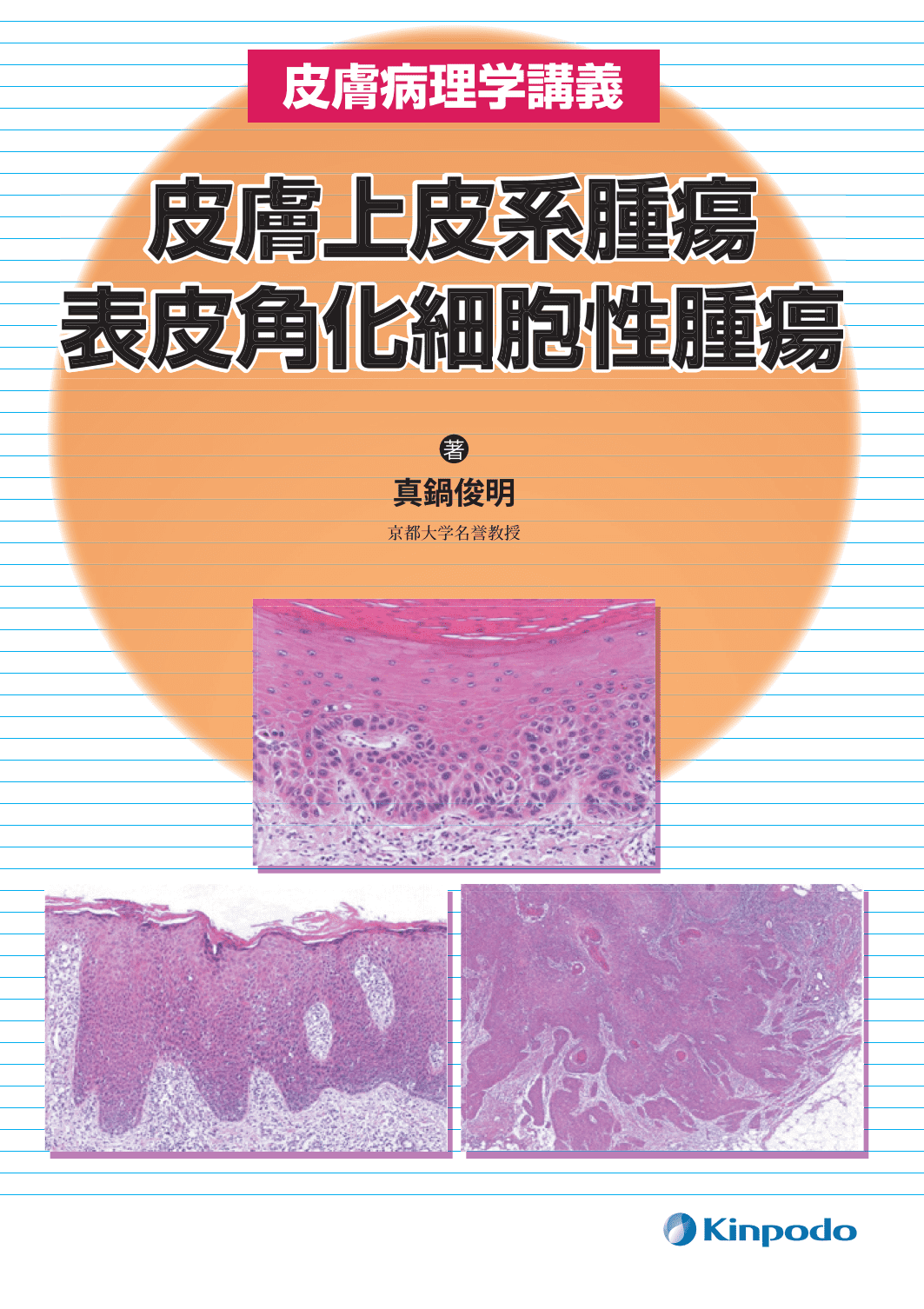 皮膚病理学講義 皮膚上皮系腫瘍 表皮角化細胞性腫瘍 - 株式会社 金芳堂