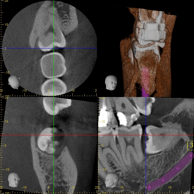 親知らず抜歯症例 歯冠除去術で神経損傷を防ぎたい。 - 症例・治療例