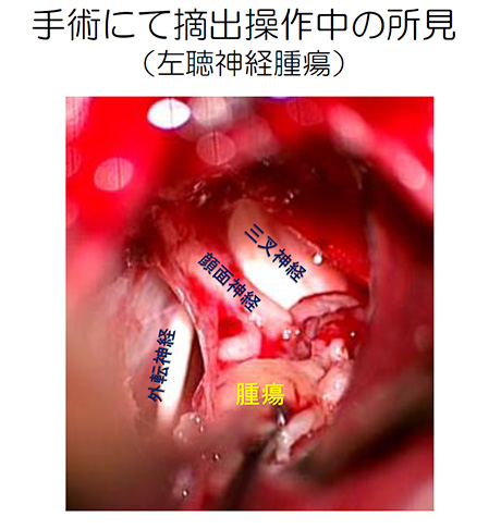 聴神経腫瘍｜診療内容｜臨床｜神戸大学医学部附属病院 脳神経外科