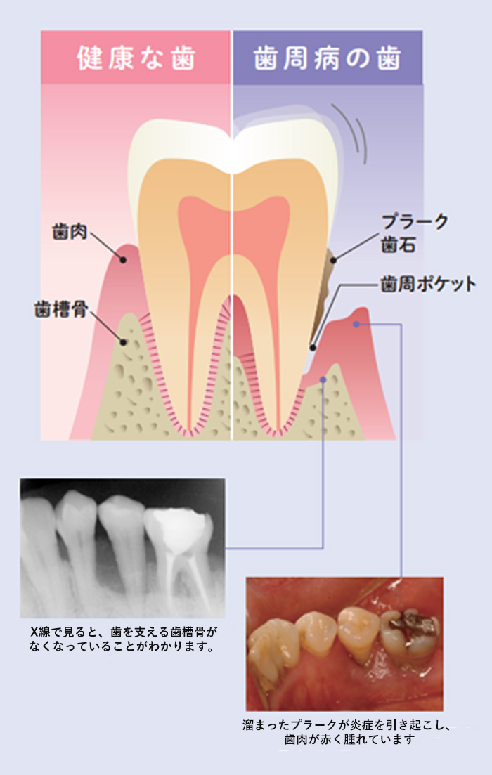 歯周外科手術 | さとう歯科（兵庫県尼崎市の歯医者）