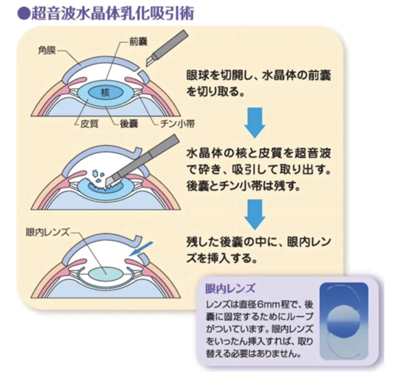 白内障手術 Cataract Surgery | 医療法人社団有慶会 横浜井土ヶ谷アイ