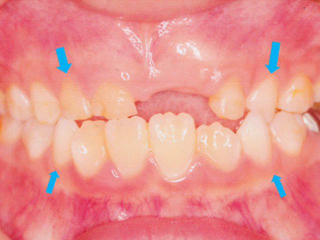 ムーシールドとインビザラインファーストによる矯正1期治療の症例
