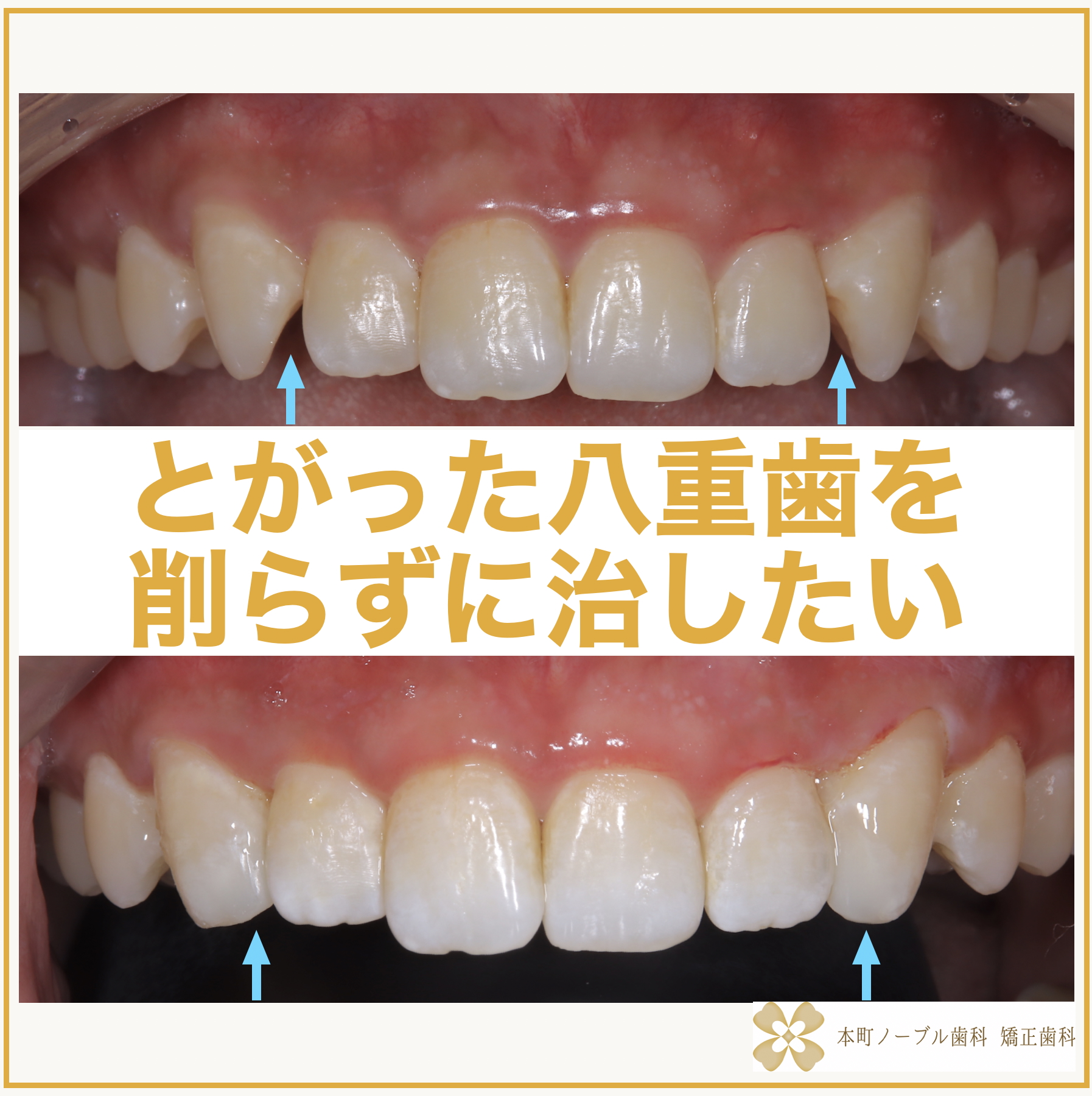 とがって、斜めにはえてることですきっ歯で攻撃的に見える八重歯を歯を