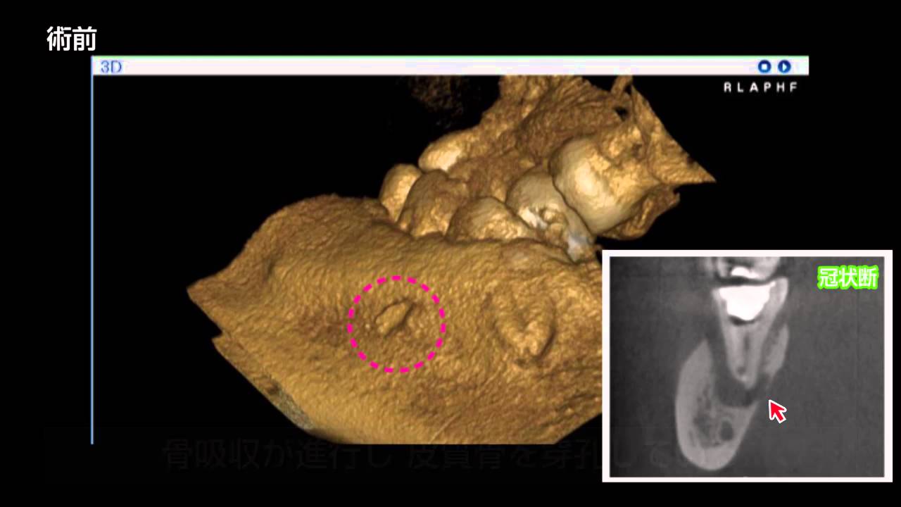 歯内療法先進技能習得教材実習項目：会員向け資料：日本歯内療法学会