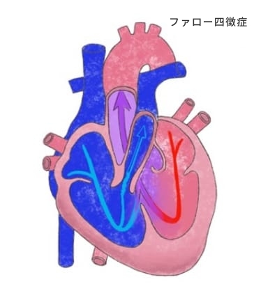 先天性心疾患｜順天堂医院 心臓血管外科
