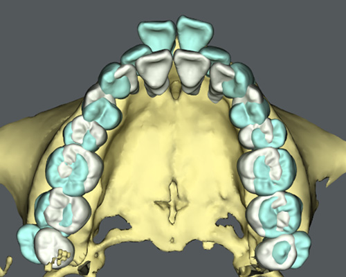3Dデジタル矯正システム | 旭川公園通り矯正歯科