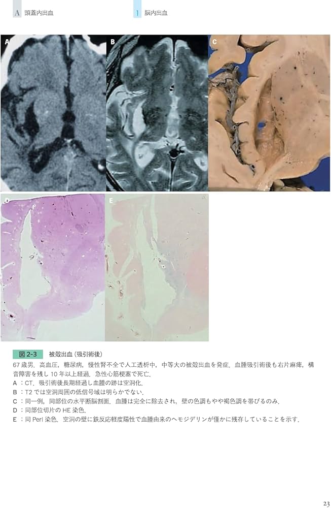 同一症例の経過・画像・病理で紐解く 臨床神経病理ワールド | 宇高不可