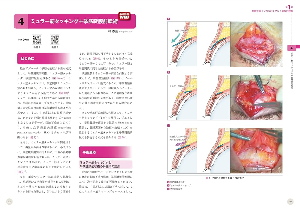 動画＆イラスト＆写真でわかる眼瞼手術の極意 advance：誰でも