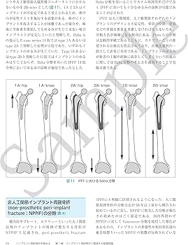 インプラント周囲骨折を極める | 馬場智規 |本 | 通販 | Amazon