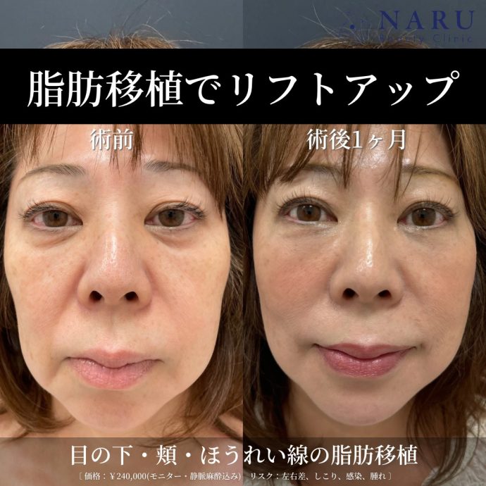若いのにほうれい線が目立つ原因と即効性のある治療法 - NARU Beauty