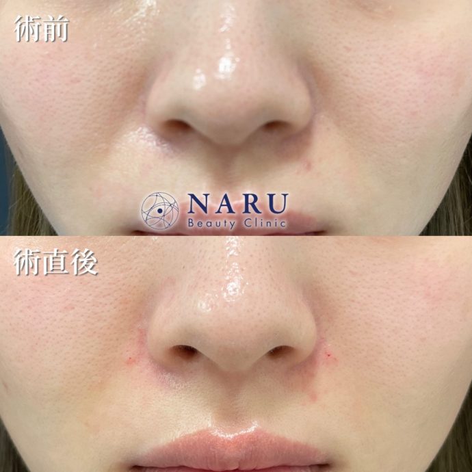 若いのにほうれい線が目立つ原因と即効性のある治療法 - NARU Beauty