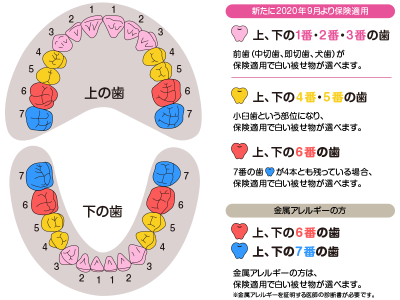CAD／CAM冠 | 診療案内 | 日航ビル歯科室｜親知らず抜歯なら川崎駅徒歩