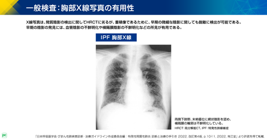 特発性間質性肺炎 診断と治療の手引き 2022 改訂第4版（静止画）｜べー