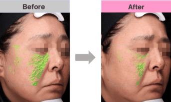 BEAUTE DE LABO éclat II 美顔器 保証書つき 未開封 BEAUTE DE LABO