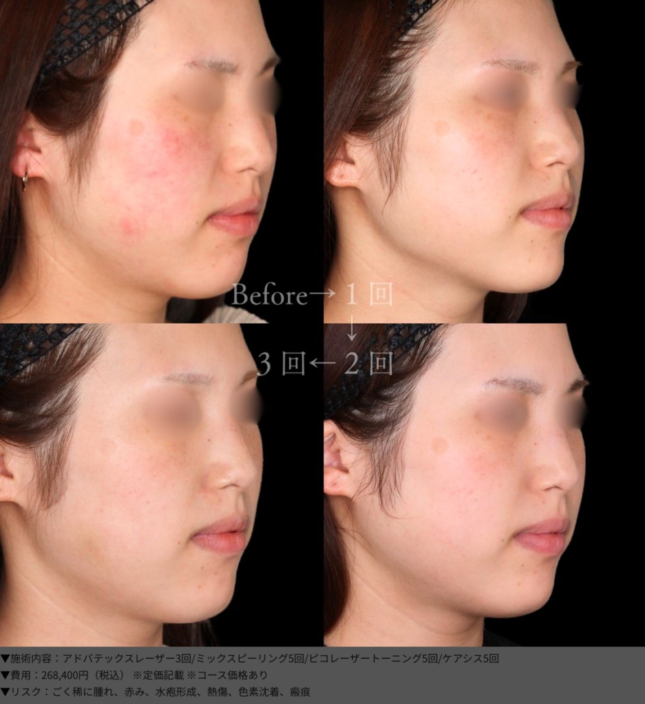 Toto様 ステップアップ皮膚レーザー エキスパートのアプローチ Toto様