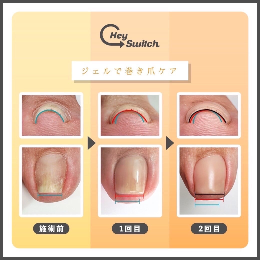 韓国発！ジェルで巻き爪ケアができる話題の『ヘイスイッチ』セミナー