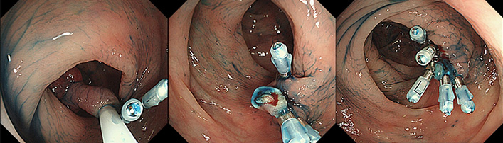 内視鏡治療はどんな治療？（日帰り内視鏡手術） | 医療法人社団山力会